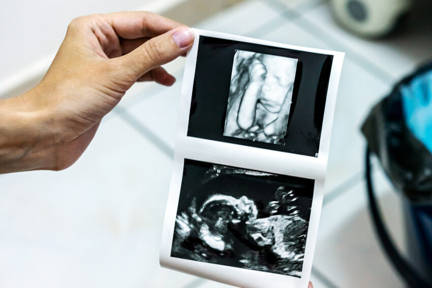 2D 3D Gender Ultrasound