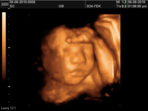 3D 4D Ultrasounds
