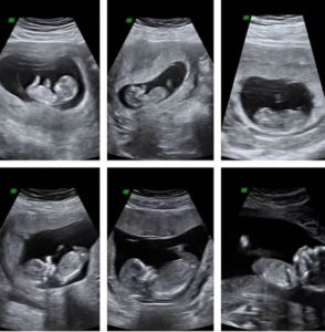 Baby-Gender Reveal DNA Test